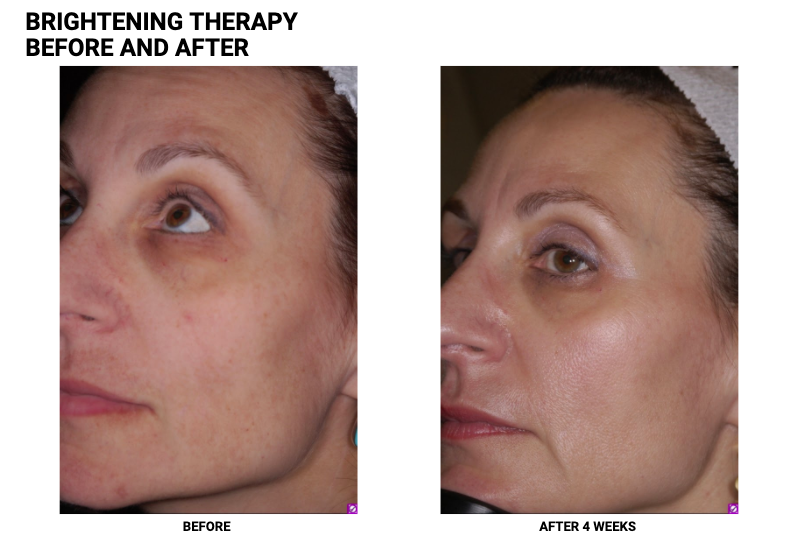 Brightening Therapy Before & After